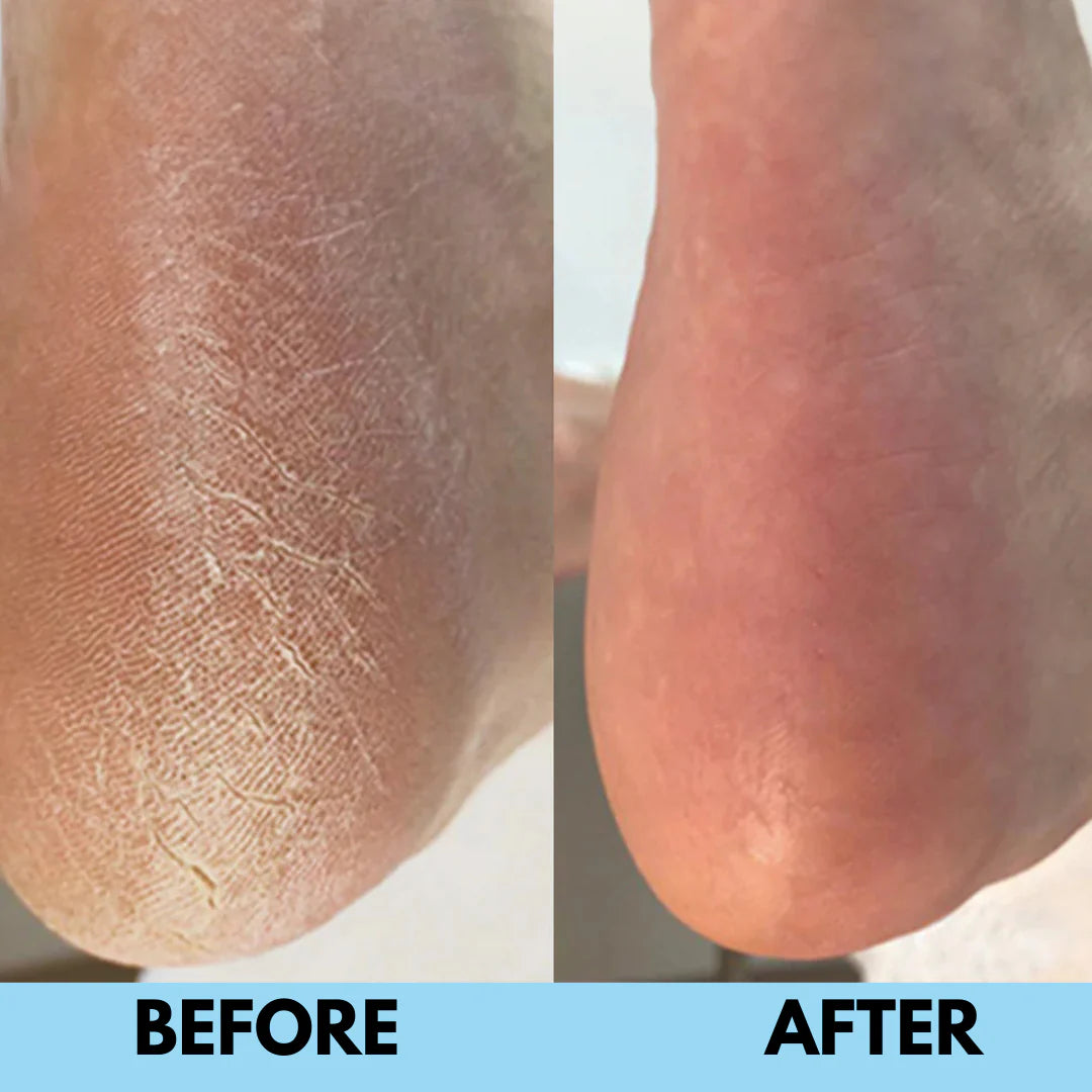 SilkSole™ | Electric Callus Remover