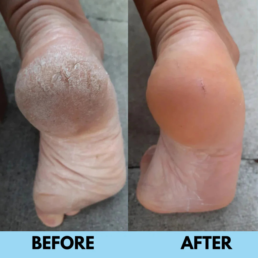 SilkSole™ | Electric Callus Remover