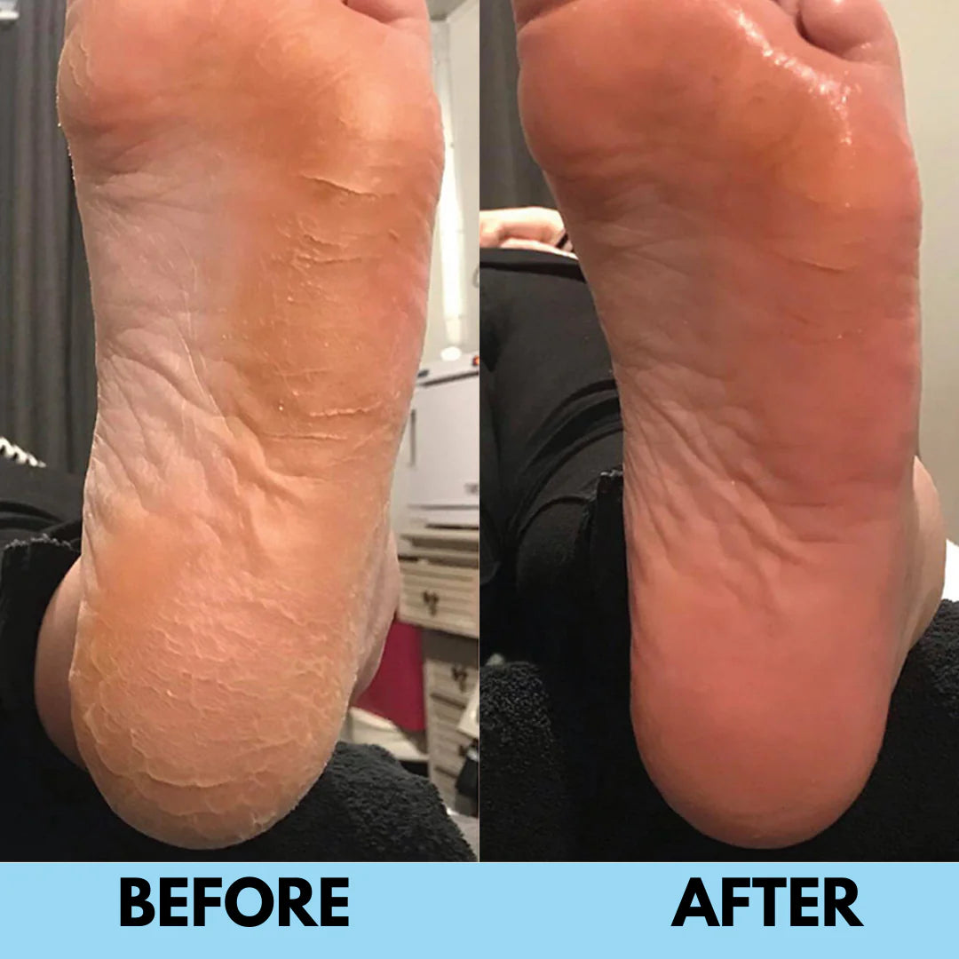 SilkSole™ | Electric Callus Remover