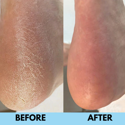 SilkSole™ | Electric Callus Remover